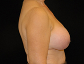 Patient # 34099 Before Photo # 5