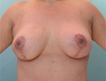 Patient # 95789 After Photo # 2