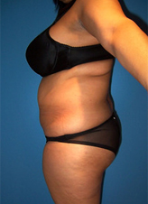 Patient # 82856 Before Photo # 3
