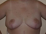 Patient # 35426 After Photo # 2