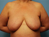 Patient # 84265 Before Photo # 1