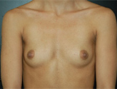 Patient # 64137 Before Photo # 1