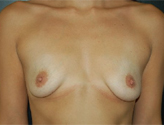 Patient # 54843 Before Photo # 1