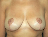 Patient # 73561 After Photo # 2