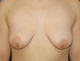 Patient # 35967 Before Photo # 1