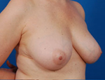 Patient # 71983 Before Photo # 3