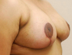 Patient # 85268 After Photo # 2