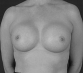 Patient # 68193 After Photo # 2