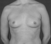 Patient # 68193 Before Photo # 1