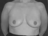 Patient # 41019 Before Photo # 1