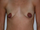 Patient # 32635 Before Photo # 1