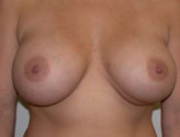Patient # 53549 After Photo # 2