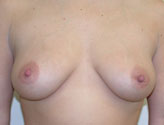 Patient # 53549 Before Photo # 1