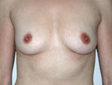 Patient # 12882 Before Photo # 1