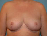 Patient # 79603 After Photo # 2