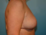Patient # 79603 After Photo # 6