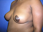 Patient # 92136 After Photo # 2