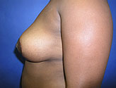 Patient # 92136 After Photo # 4