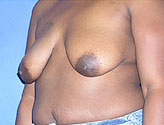 Patient # 92136 Before Photo # 1