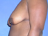Patient # 92136 Before Photo # 3