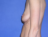 Patient # 65757 Before Photo # 3