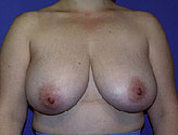 Patient # 97923 Before Photo # 1
