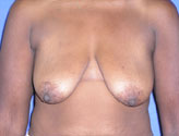 Patient # 58444 Before Photo # 1
