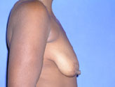 Patient # 58444 Before Photo # 3