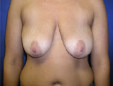 Patient # 43975 Before Photo # 1