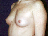 Patient # 89491 Before Photo # 1