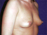 Patient # 77210 Before Photo # 1