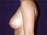 Patient # 91987 After Photo # 2