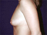 Patient # 91987 Before Photo # 1