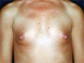 Patient # 84526 Before Photo # 1