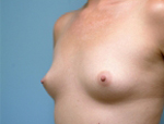 Patient # 45238 Before Photo # 1