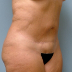 Patient # 78946 After Photo # 2