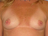 Patient # 55540 Before Photo # 1