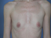Patient # 12093 Before Photo # 1
