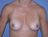Patient # 94147 After Photo # 2