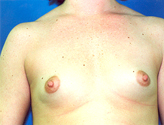 Patient # 20035 Before Photo # 1