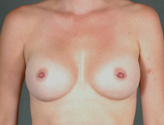 Patient # 45382 After Photo # 2