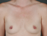 Patient # 45382 Before Photo # 1