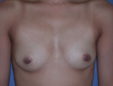 Patient # 86444 Before Photo # 1