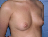 Patient # 89645 Before Photo # 1