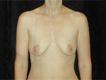 Patient # 96972 Before Photo # 1