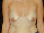 Patient # 31334 Before Photo # 1
