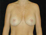 Patient # 83603 After Photo # 2