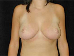 Patient # 23008 After Photo # 2