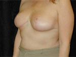 Patient # 26280 After Photo # 4