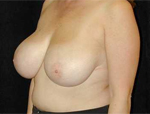 Patient # 26280 Before Photo # 3